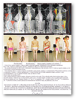 Kniha SM systém Skolióza příklad úspěšné léčby